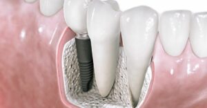 implantes dentales carabanchel