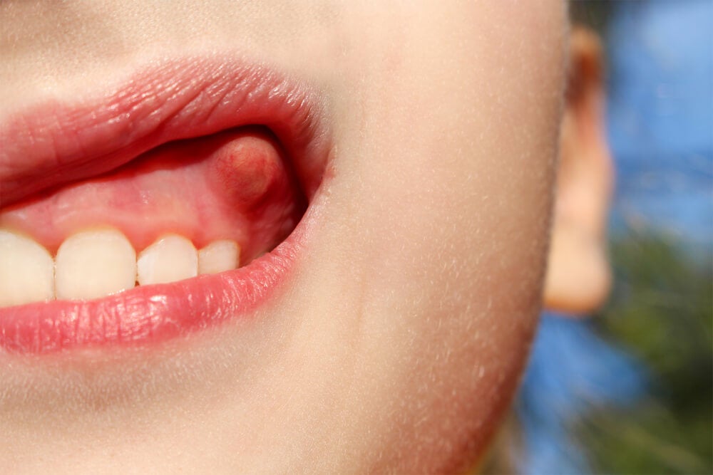 ¿Qué es y como se trata un flemón dental?