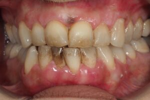 periodontitis fumador 1