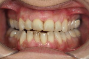 periodontitis fumador 2
