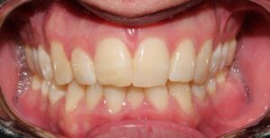 CASO ortodoncia COMPREHENSIVE antes