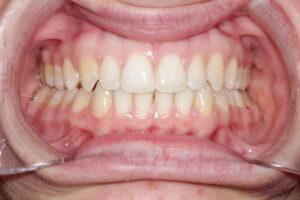 caso clínico ortodoncia invisalign lite antes