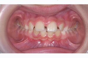 caso ortodoncia INVISALIGN FIRST antes copia