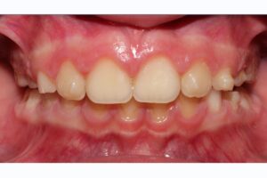 caso ortodoncia INVISALIGN FIRST después