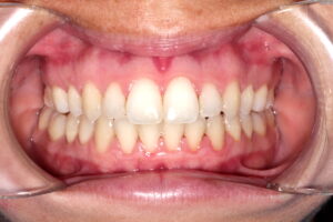 caso tratamiento ortodoncia invisalign madrid después..