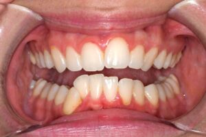 tratamiento ortodoncia INVISALIGN COMPREHENSIVE (FULL) antes