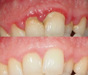 qué es la enfermedad periodontal