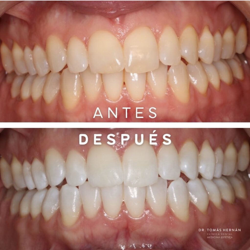 Aspectos Básicos del Blanqueamiento Dental