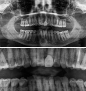 radiografía bucal extraoral clinica carabanchel