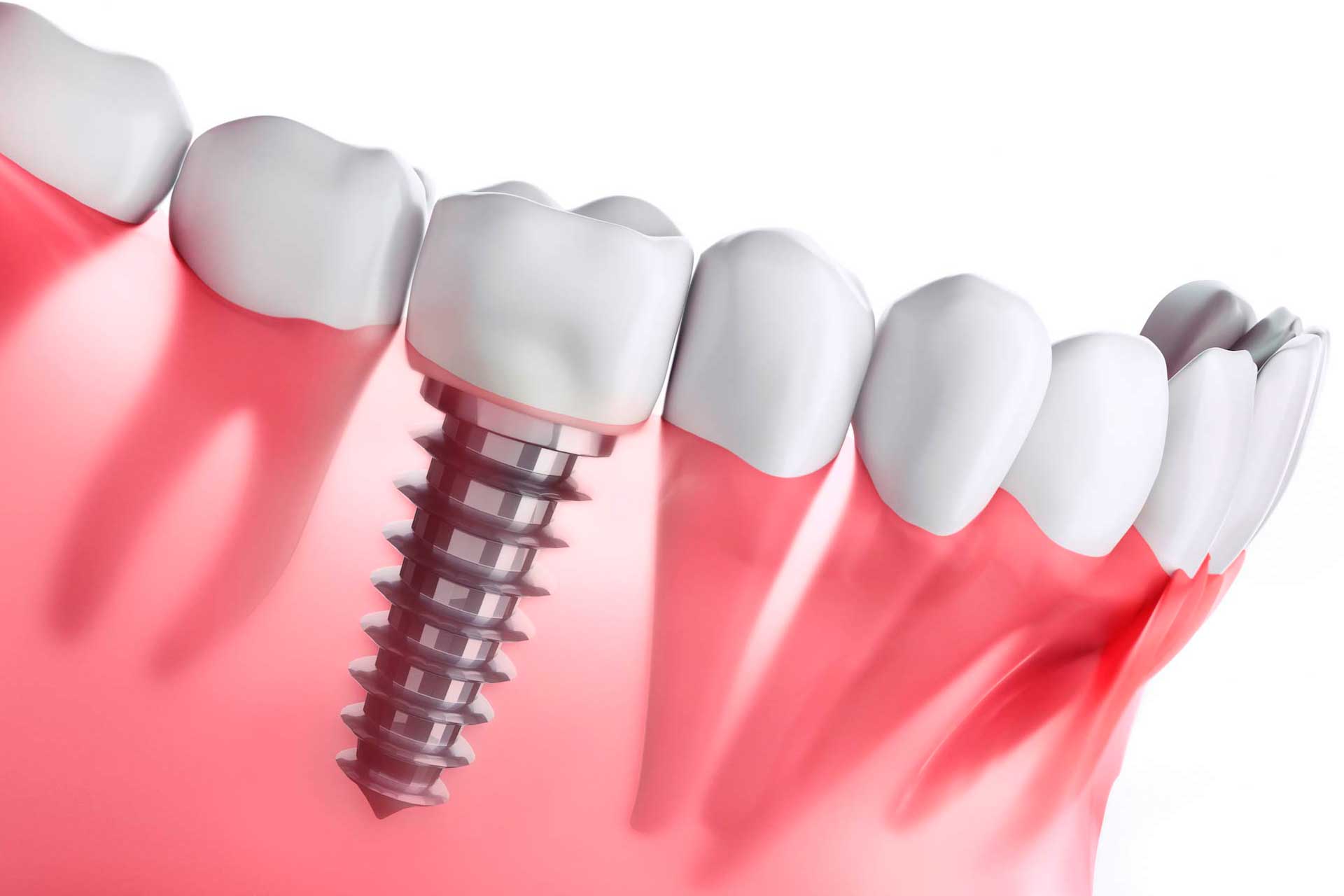 Mitos y Verdades sobre Implantes Dentales