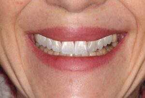 dental smile design