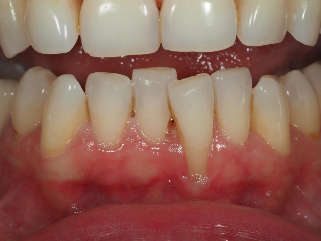 Recesión Gingival Madrid