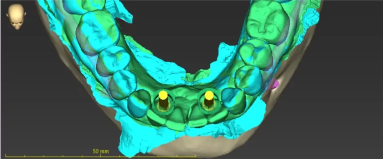 implantes dentales carga inmediata