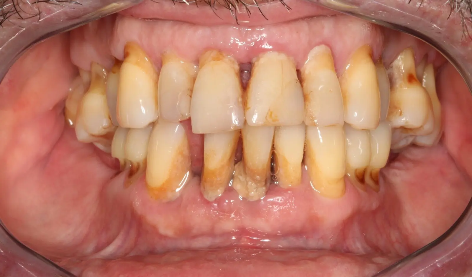 Antes
